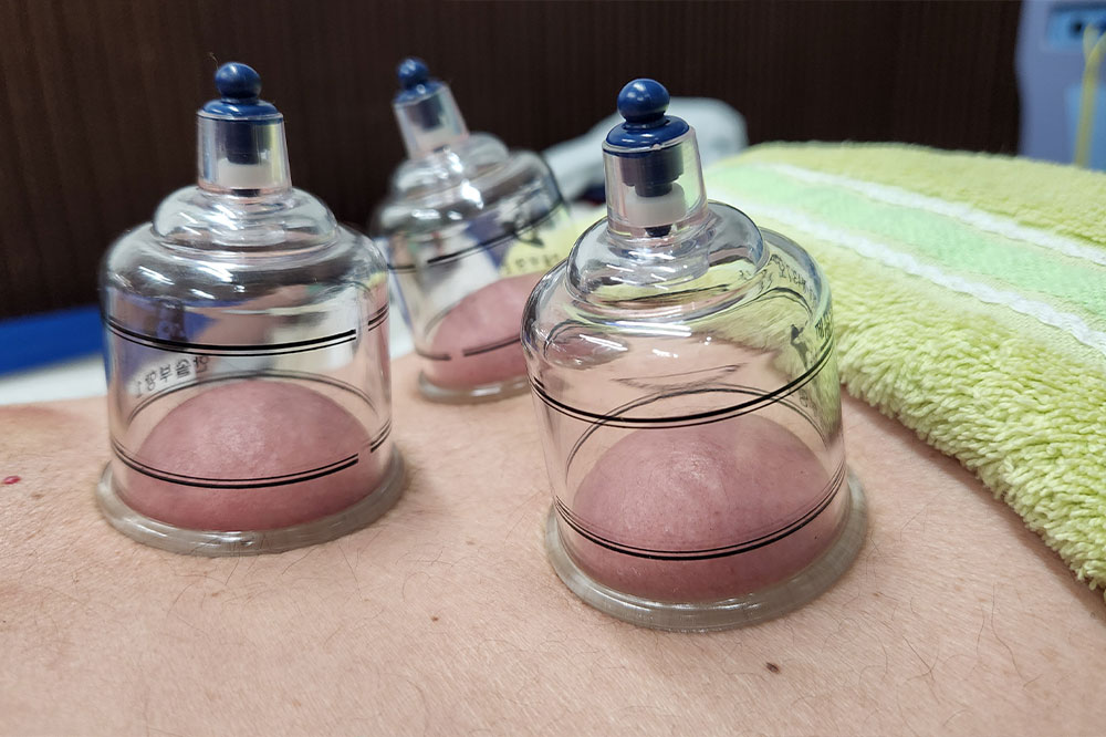 カッピング療法(吸い玉、吸角)
